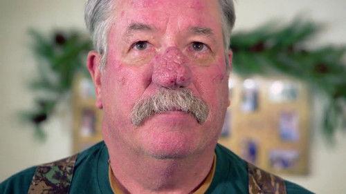 Dr. Pimple Popper Season 2 Episode 5 - Every Rosacea Has Its Thorn