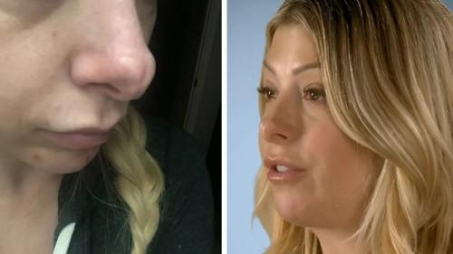 Botched Season 5 Episode 14 - Welcome to Jurassic Schnoz